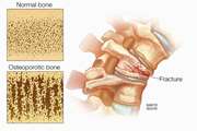 New horizons in treatment of osteoporosis