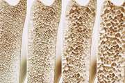 Evaluation of bone mineral density and its influencing factors in patients infected with HIV under antiretroviral therapy