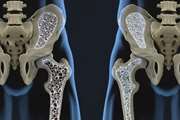  Osteoporosis in Iranians: a silent threat to the health of the elderly in Iran