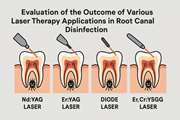 Evaluation of the outcome of various laser therapy applications in root canal disinfection: A systematic review