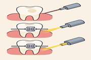 Effect of laser-assisted bleaching with Nd:YAG and diode lasers on shear bond strength of orthodontic brackets