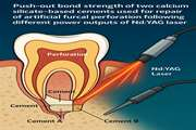 Push-out bond strength of two calcium silicate-based cements used for repair of artificial furcal perforation following different power outputs of Nd:YAG laser 
