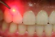 Efficacy of Nd:YAG laser-assisted periodontal therapy for the management of periodontitis: A double-blind split-mouth randomized controlled clinical trial 