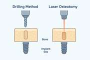 Laser-Assisted Osteotomy for Implant Site Preparation: A Literature Review