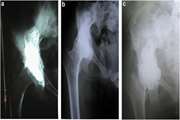  	Acetabular Hydatid Cyst in a Teenage Girl: A Rare Manifestation and Successful Long-Term Management With Combined Surgical and Anthelmintic Approaches