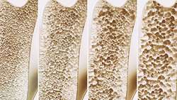 Evaluation of bone mineral density and its influencing factors in patients infected with HIV under antiretroviral therapy