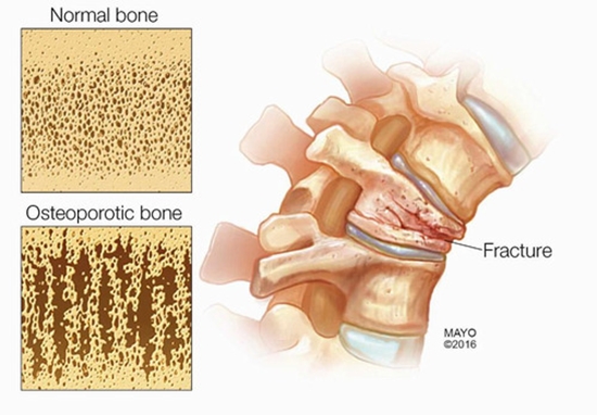 osteoporosis {faces}