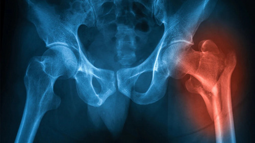 Mortality and re-fracture rates in low trauma hip fracture