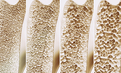 Evaluation of bone mineral density and its influencing factors in patients infected with HIV under antiretroviral therapy