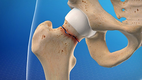 The process of hip fracture management before and during the COVID-19 pandemic in Iran