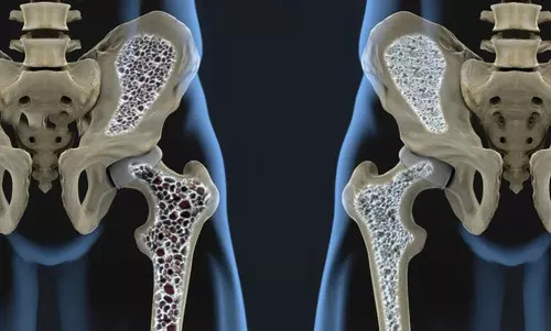  Osteoporosis in Iranians: a silent threat to the health of the elderly in Iran